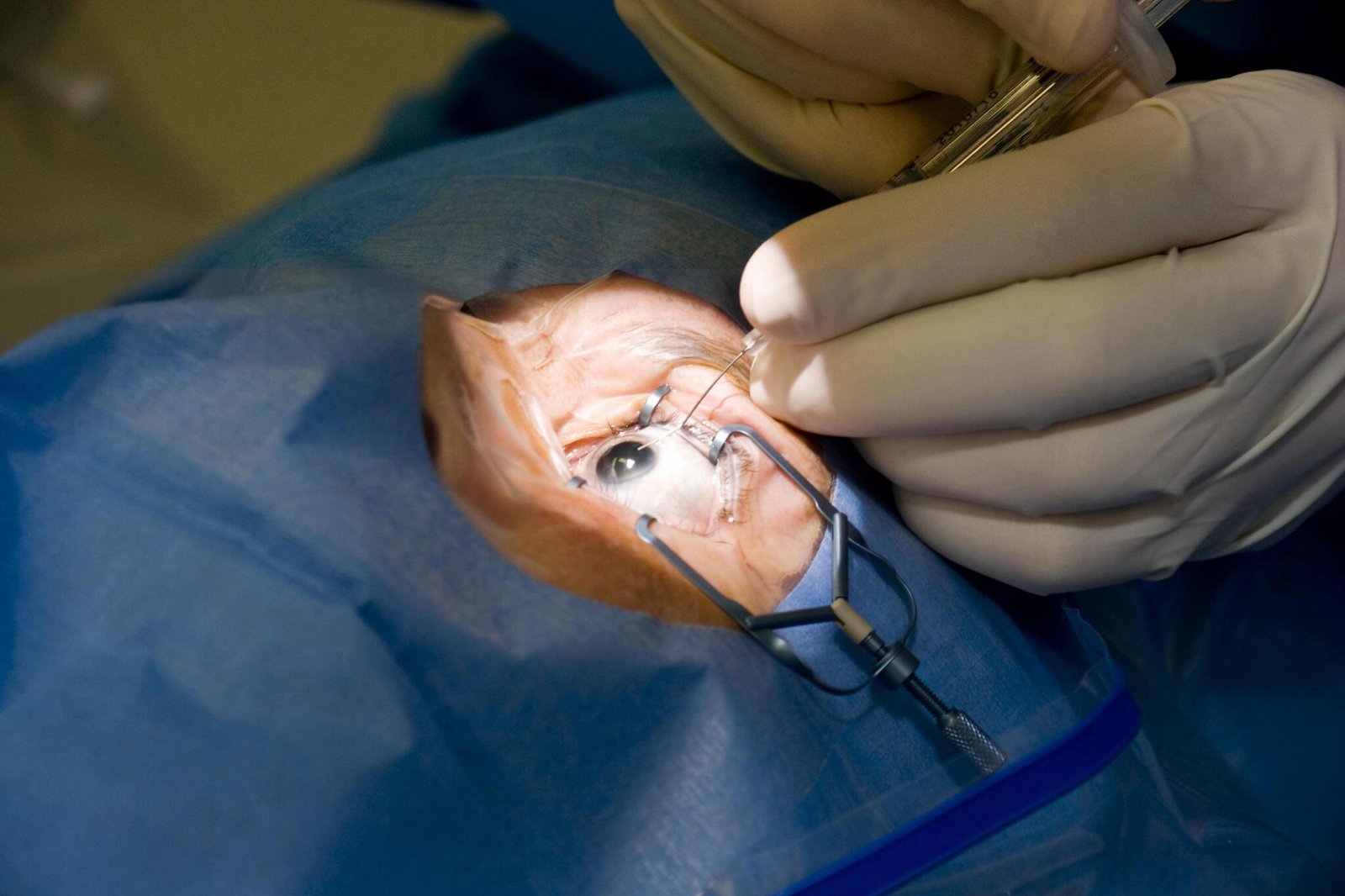 Cataract surgery in Hyderabad