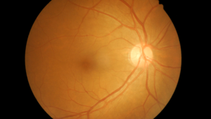 Glaucoma Treatment in Hyderabad – Symptoms, Causes & Care