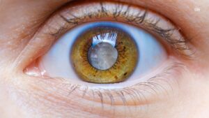 Advancements in Cataract Surgery in Hyderabad – A Complete Guide